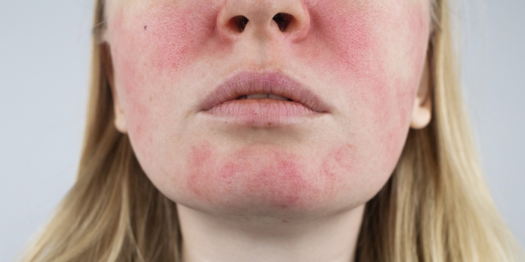 Rosacea neboli růžovka. Co to vlastně je a jak s ní bojovat