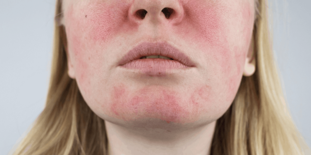 Rosacea neboli růžovka. Co to vlastně je a jak s ní bojovat?