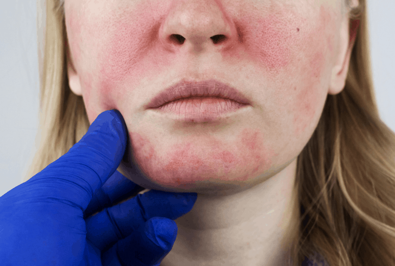 Rosacea neboli růžovka. Co to vlastně je a jak s ní bojovat?